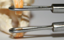 Anwendungsbeispiel einer Maulsperre